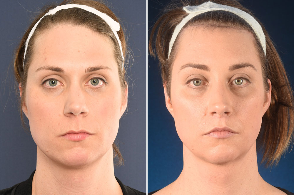 Facial surgery trama