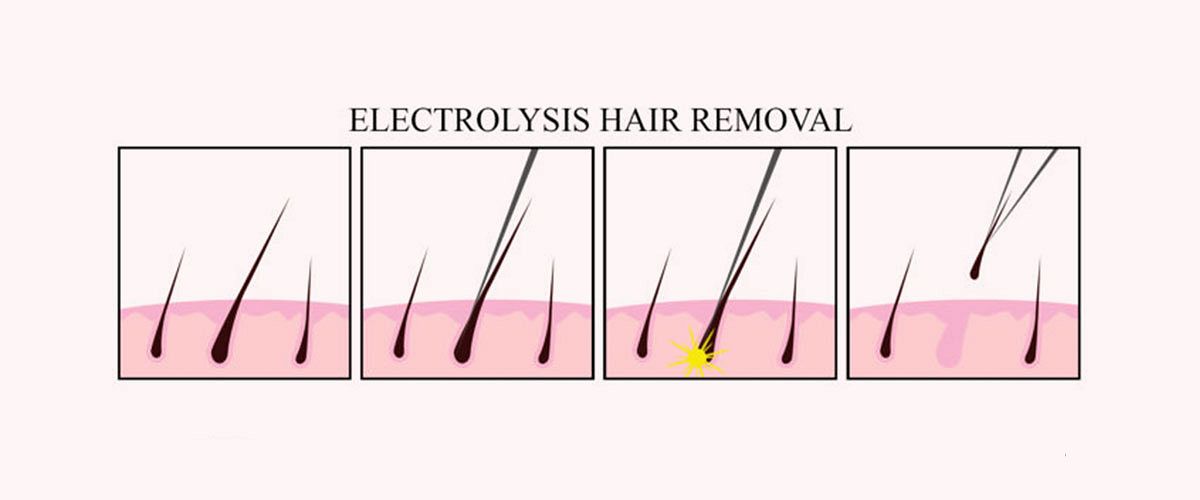 Electrolysis to shave a cunt