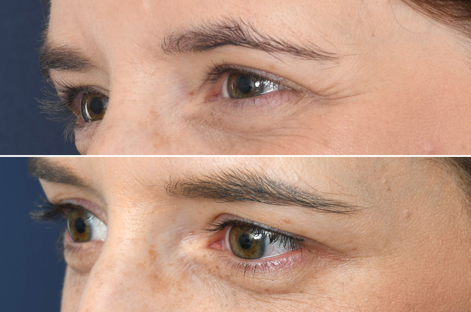 2passclinic before and after transwomen permanent make-up eyeliner