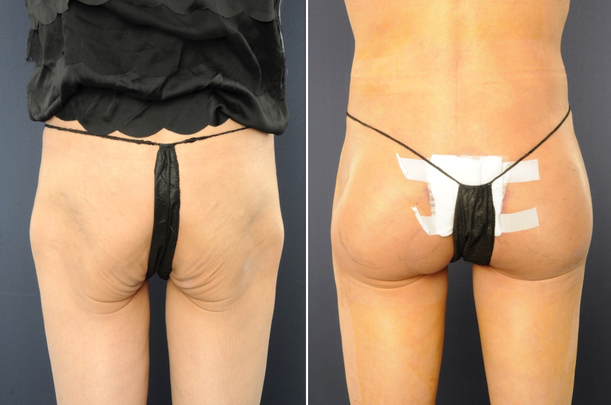 Buttock Augmentation Recovery Time