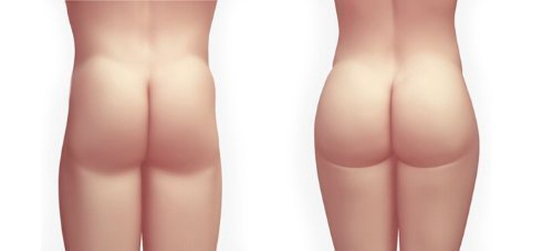 Buttock Implants Surgery (Bigger and Rounder Butt)