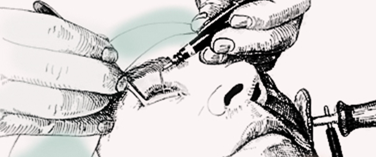 A small current with a long history electrolysis hair removal 2pass