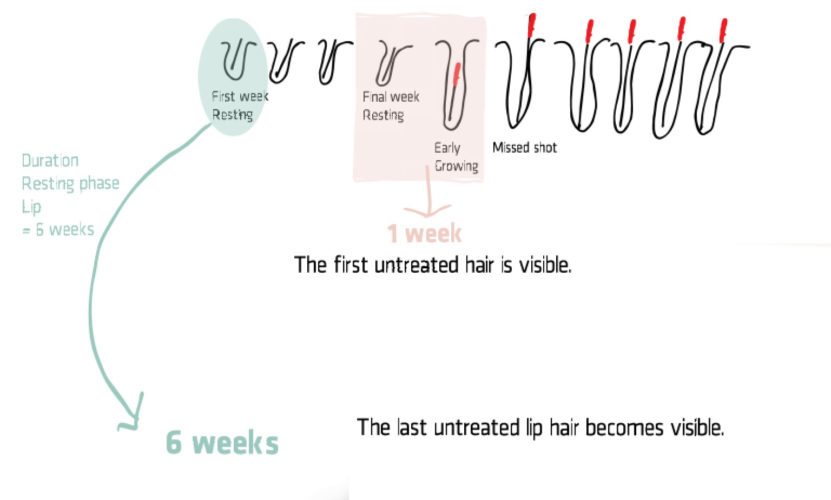 Does hair regrow after electrolysis hair removal? - 2pass Clinic