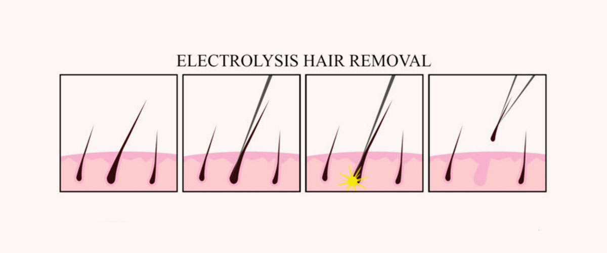 Is electrolysis hair removal painful? - 2pass Clinic