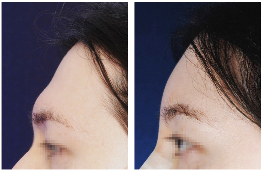 Brow bone reduction - type 4 - forehead reconstruction and filling (before and after) | 2pass Clinic