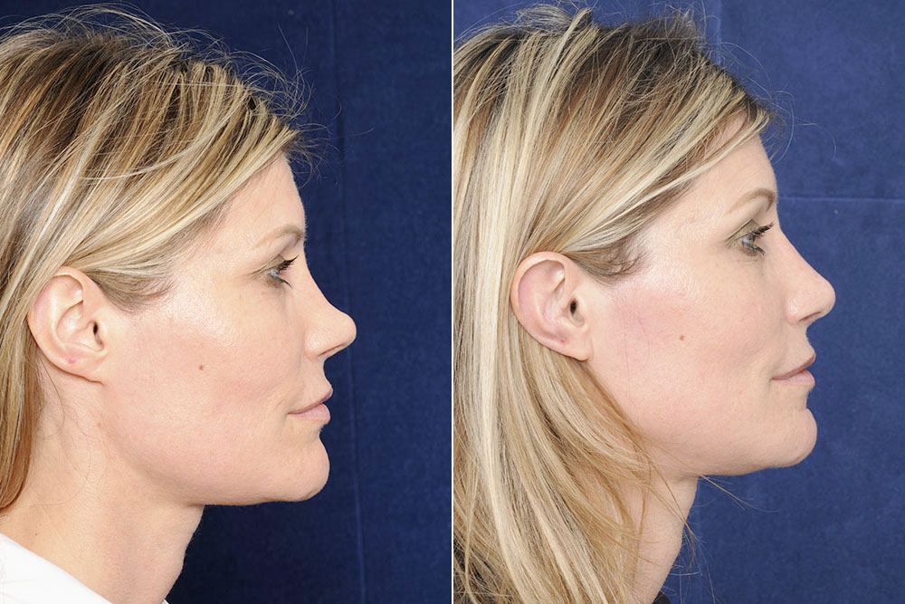 2pass Clinic - rhinoplasty - before and after