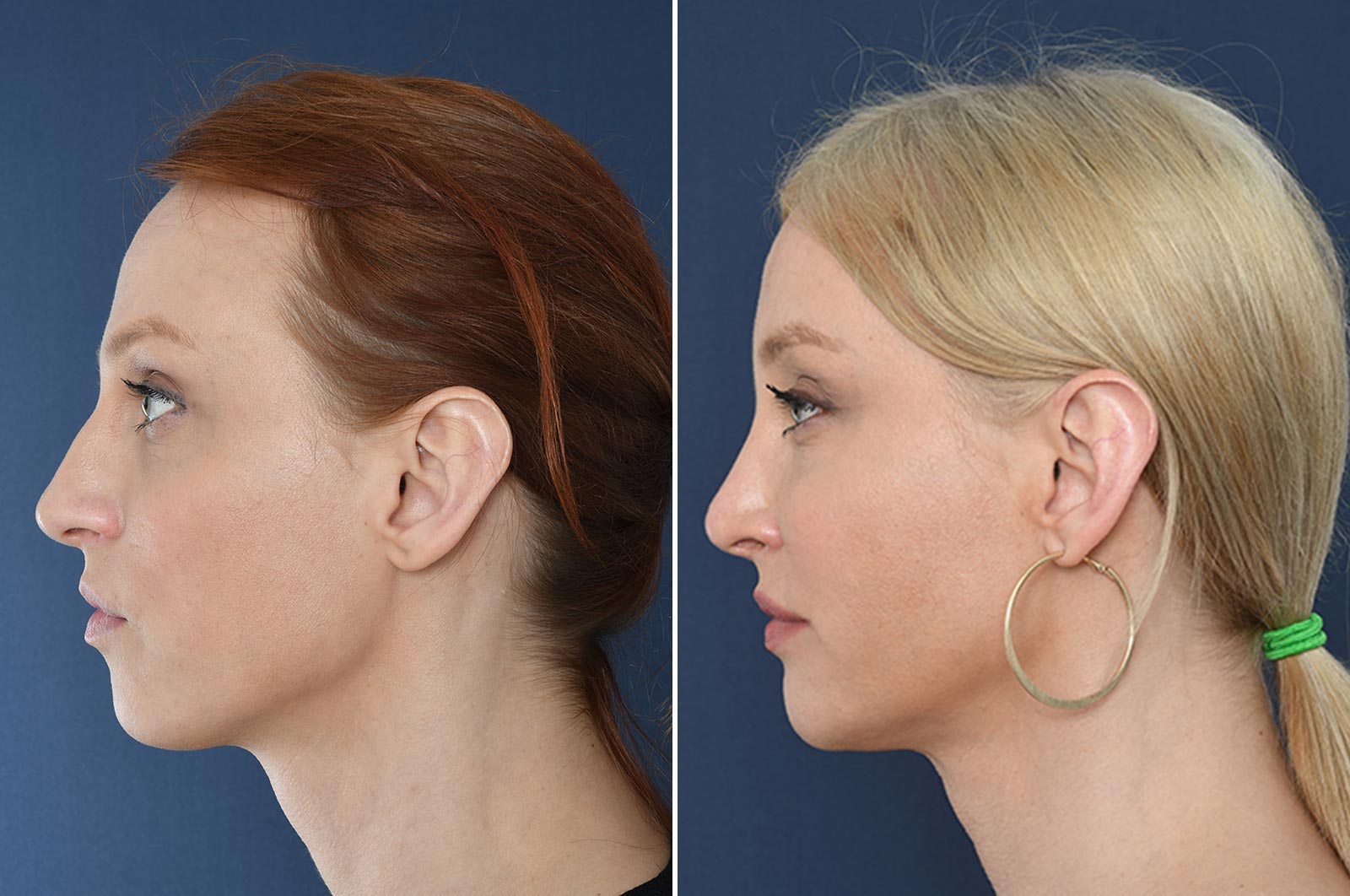 2pass Clinic - rhinoplasty - before and after 2