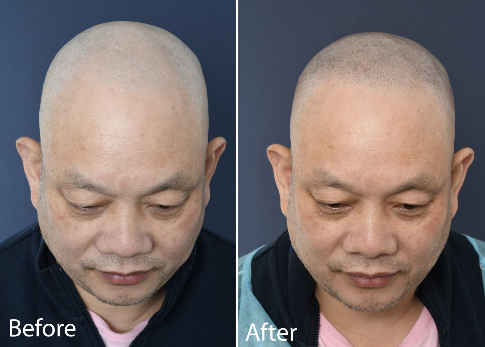 What is micro hair pigmentation or scalp micropigmentation? - 2pass Clinic