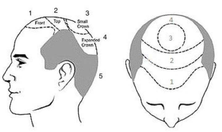 What is micro hair pigmentation or scalp micropigmentation? - 2pass Clinic