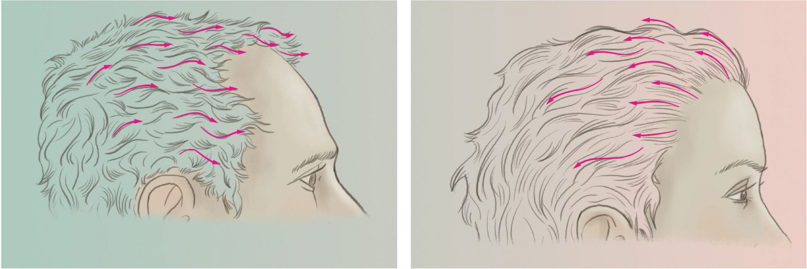 El flujo del cabello en la línea del cabello masculina vs femenina