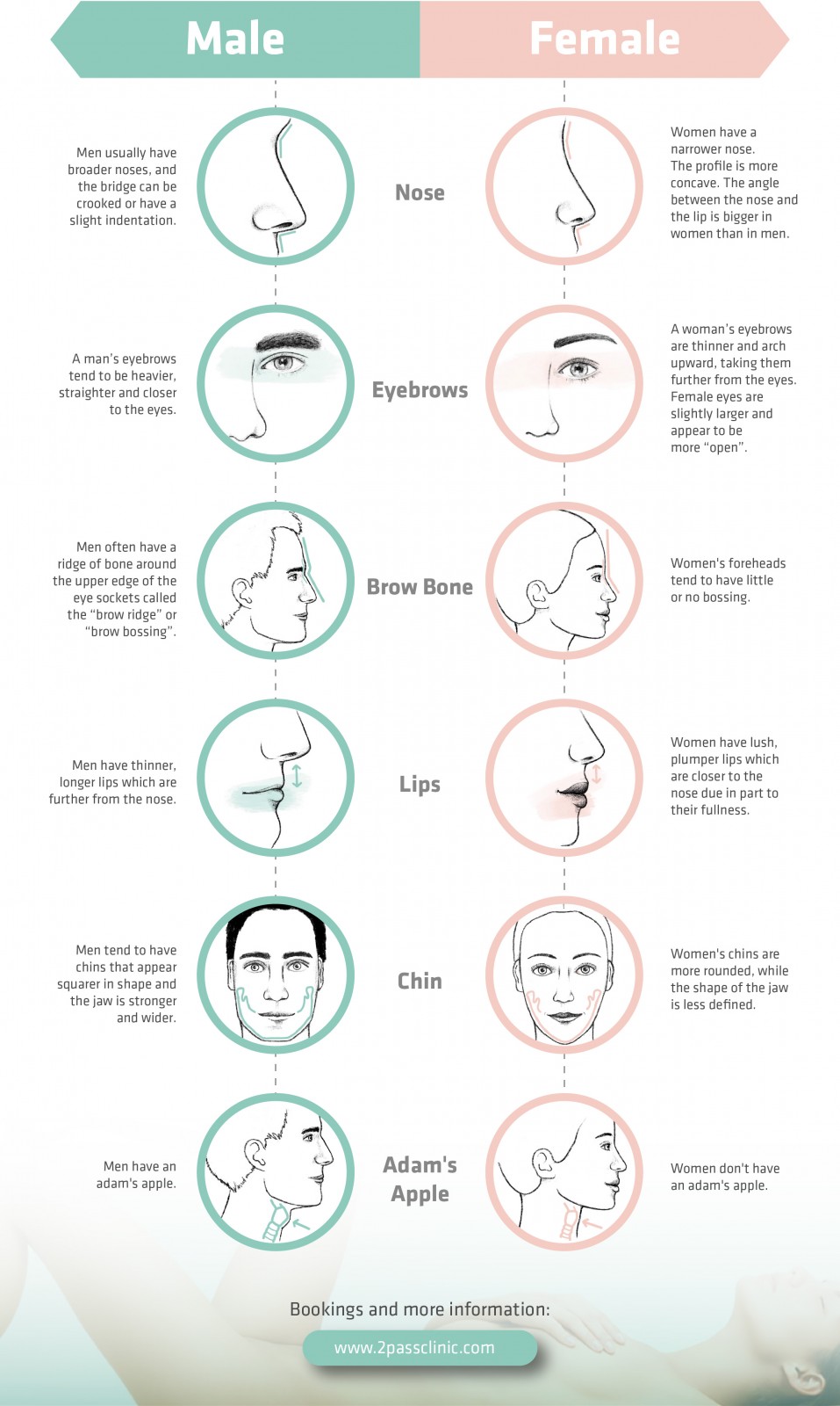 Infographic showing the 6 key differences between male and female faces that can be addressed by FFS