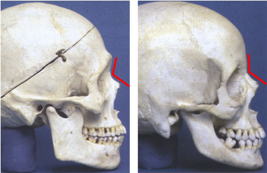2passclinic before and after transwomen facial feminization FFS mtf antwerp brow bone reduction