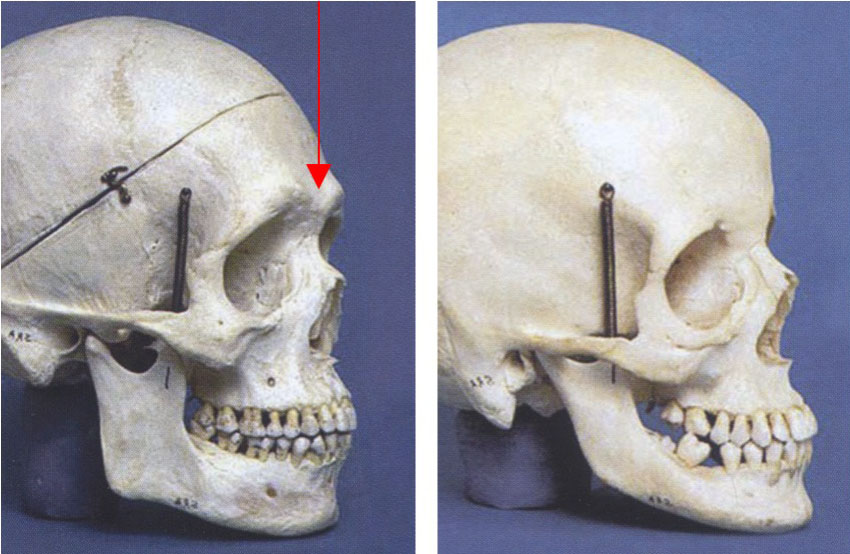 2passclinic before and after transwomen facial feminization FFS mtf antwerp brow bone reduction