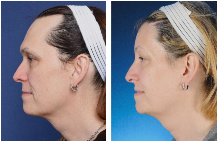 2passclinic before and after transwomen facial feminization FFS mtf antwerp brow bone reduction type 3