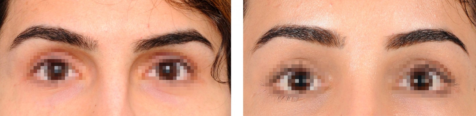 2passclinic before and after transwomen facial feminization FFS mtf antwerp brow lift