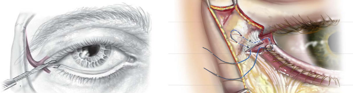 2passclinic before and after transwomen facial feminization FFS mtf canthoplasty