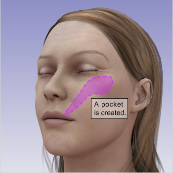 2passclinic before and after transwomen facial feminization FFS mtf cheek augmentation