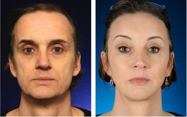 2passclinic before and after transwomen facial feminization FFS mtf cheek augmentation