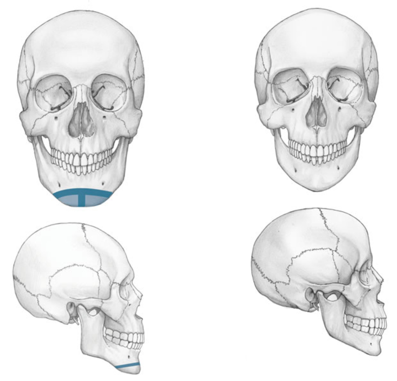 cleft chin removal before and after