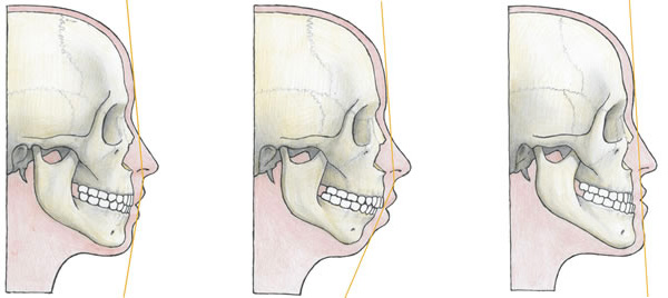 2passclinic before and after transwomen facial feminization FFS mtf antwerp chin surgery