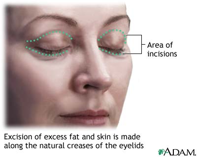 blepharoplasty eyelid surgery cost