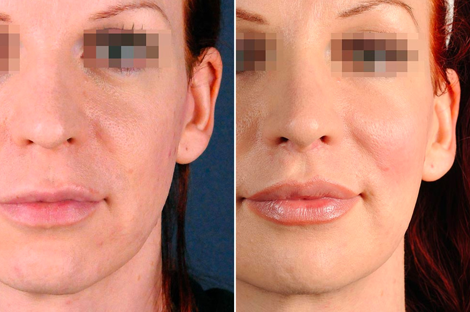 2passclinic before and after transwomen facial feminization FFS mtf antwerp facelift surgery