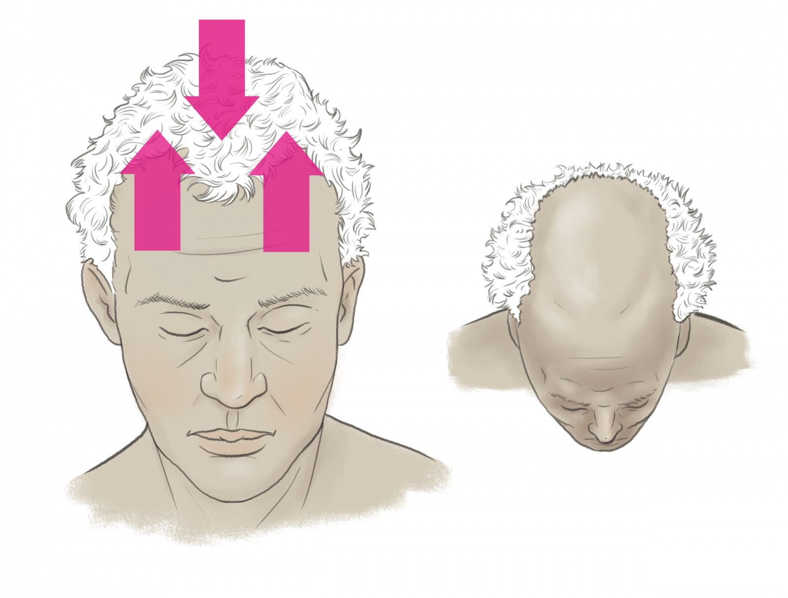 Male pattern baldness