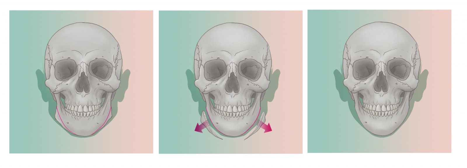 Jaw Recontouring, Angle Reduction, V-Line Face - Tes Clinic for Face and Jaw