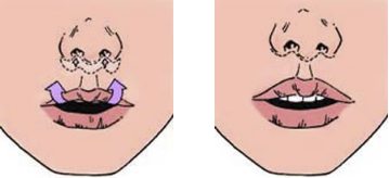 2passclinic before and after transwomen facial feminization FFS mtf antwerp lip lift