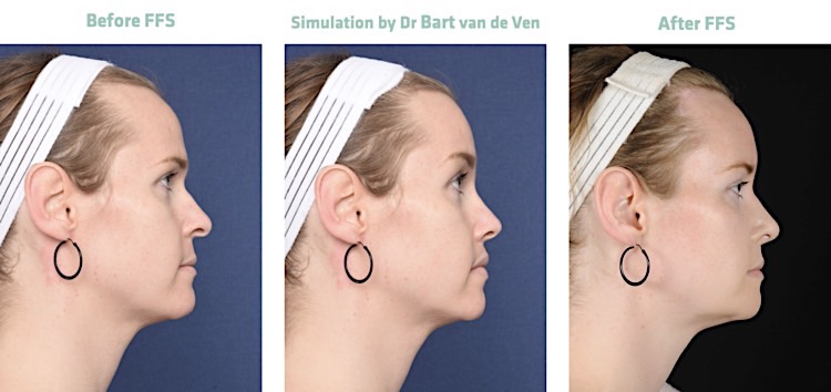 Facial Feminization Surgery Get Your Own Picture Simulation For Facial Feminization Surgery 