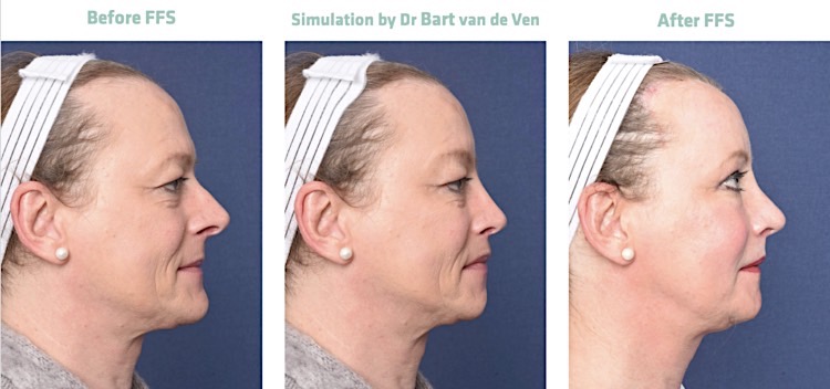 2passclinic before and after transwomen facial feminization FFS mtf antwerp