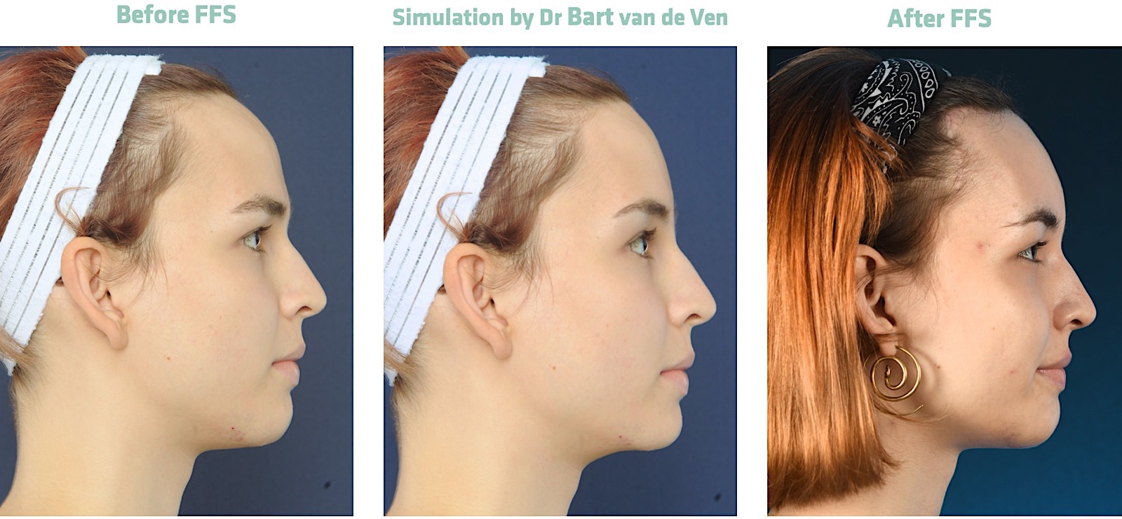 Facial Feminization Surgery Get Your Own Picture Simulation For Facial Feminization Surgery 