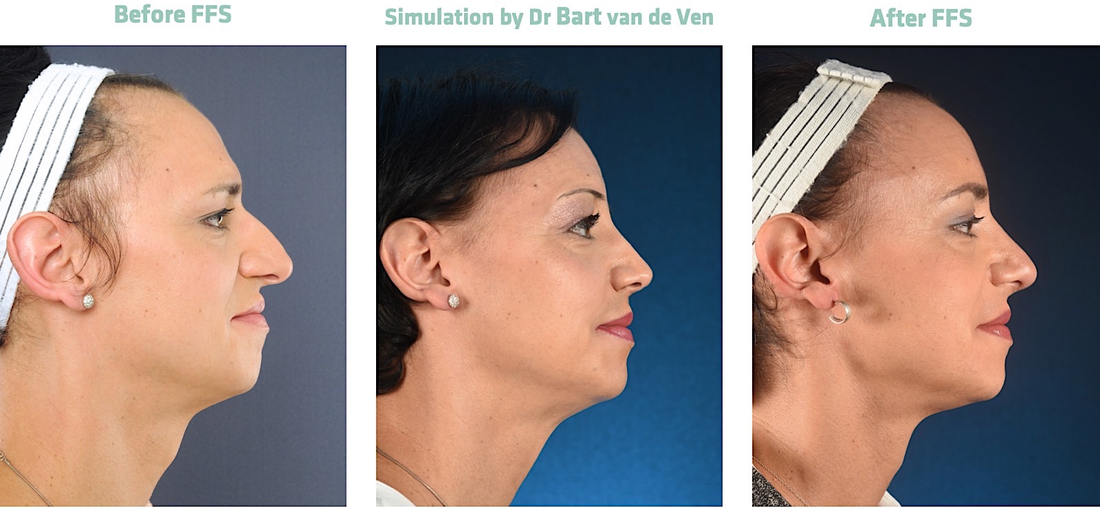 Get your own picture simulation of a Facial Feminization ...