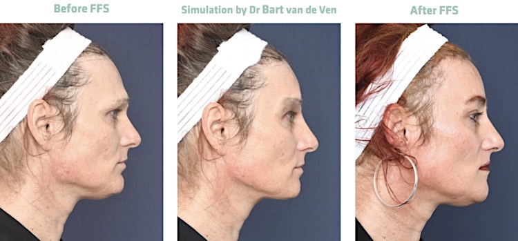 2passclinic before and after transwomen facial feminization FFS mtf antwerp