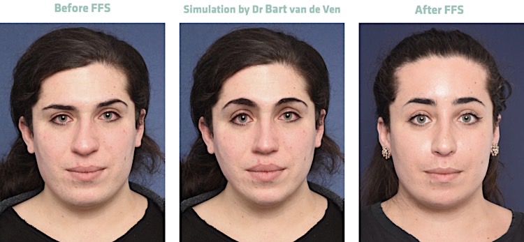 2passclinic before and after transwomen facial feminization FFS mtf antwerp