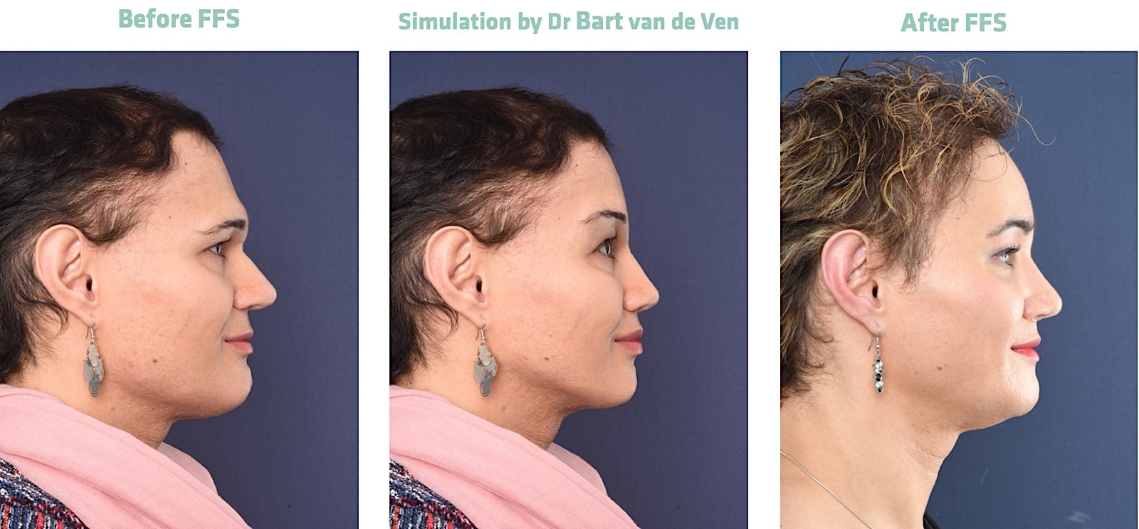 2passclinic before and after transwomen facial feminization FFS mtf antwerp