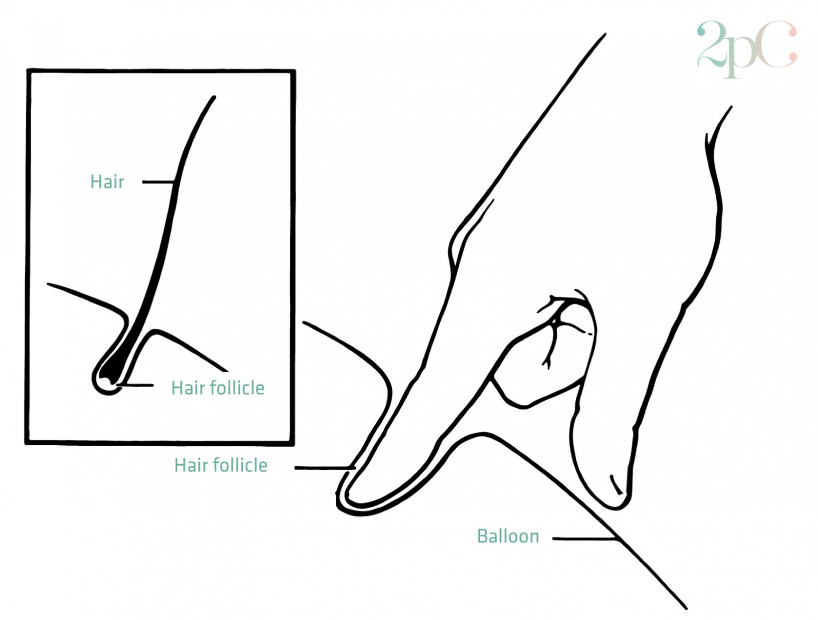 Hair removal Electrolysis for permanent hair removal o2 Clinic