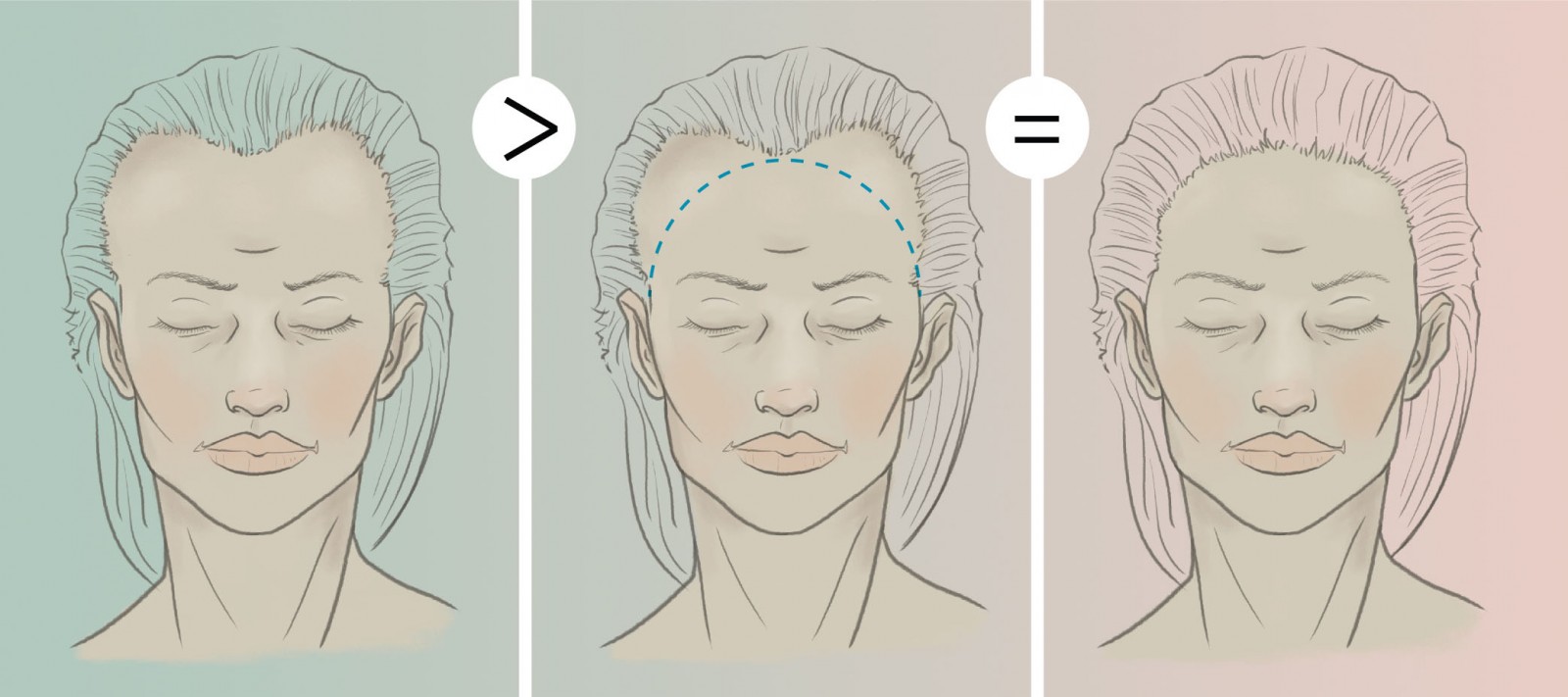 Breast growth during the first year of HRT: what can I expect? - 2pass  Clinic