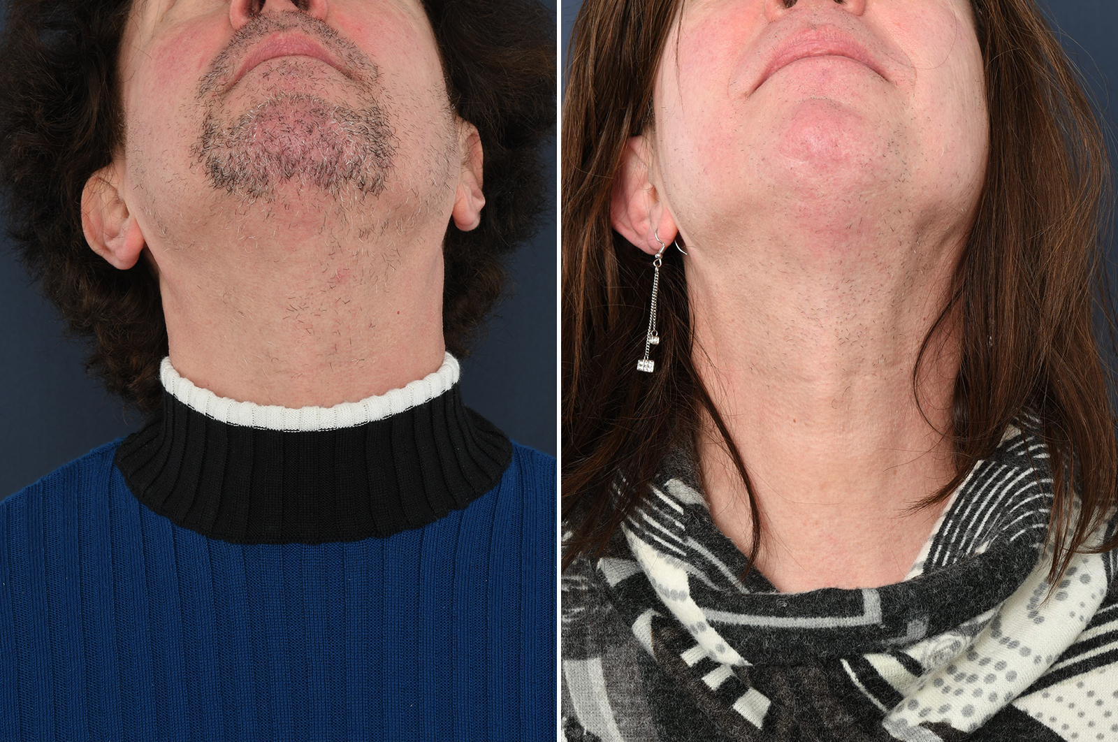 Result after 56 hours of electrolysis before and after FFS 2pass Clinic
