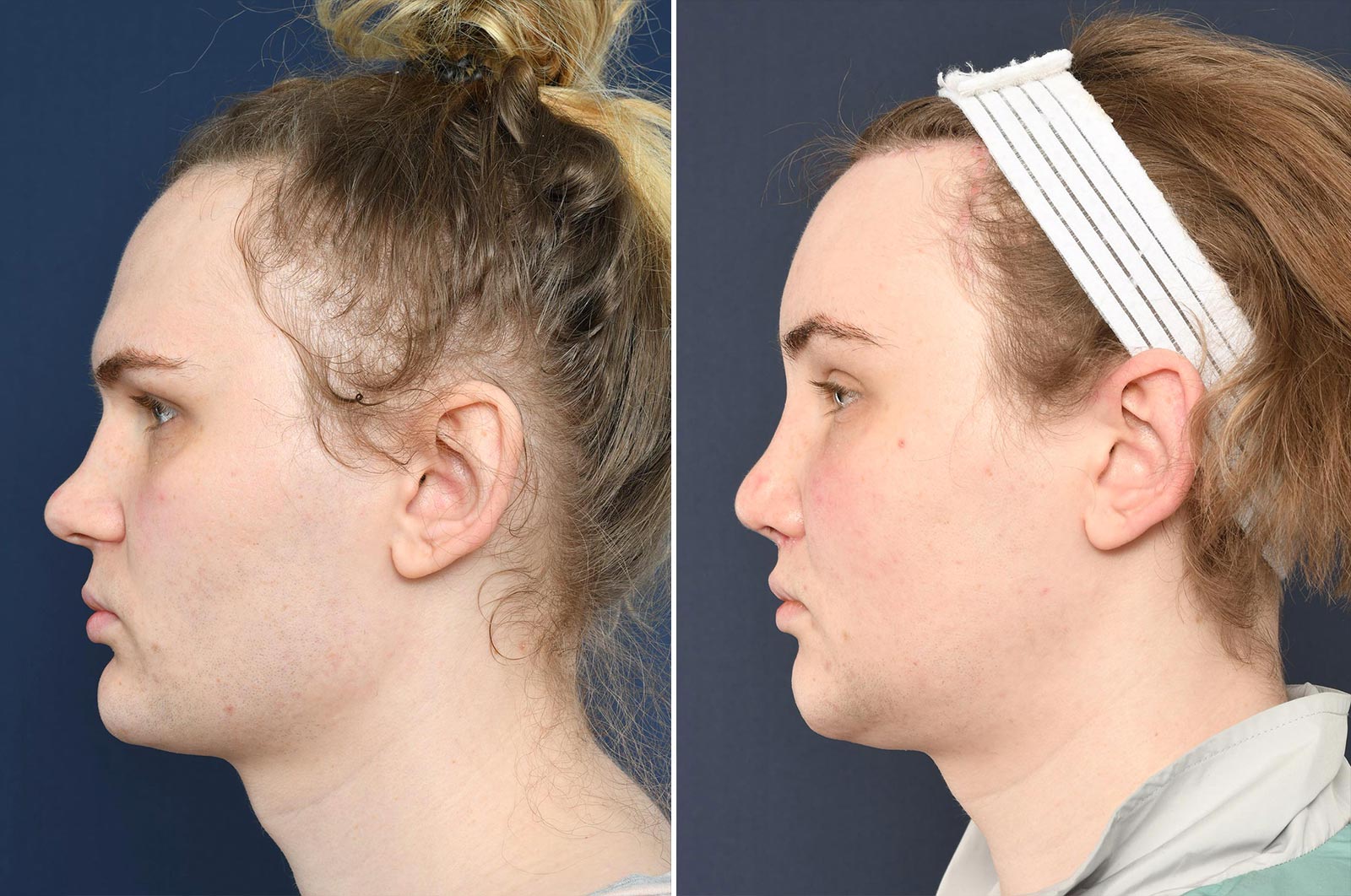 Evelyn Before And After Ffs 2pass Clinic