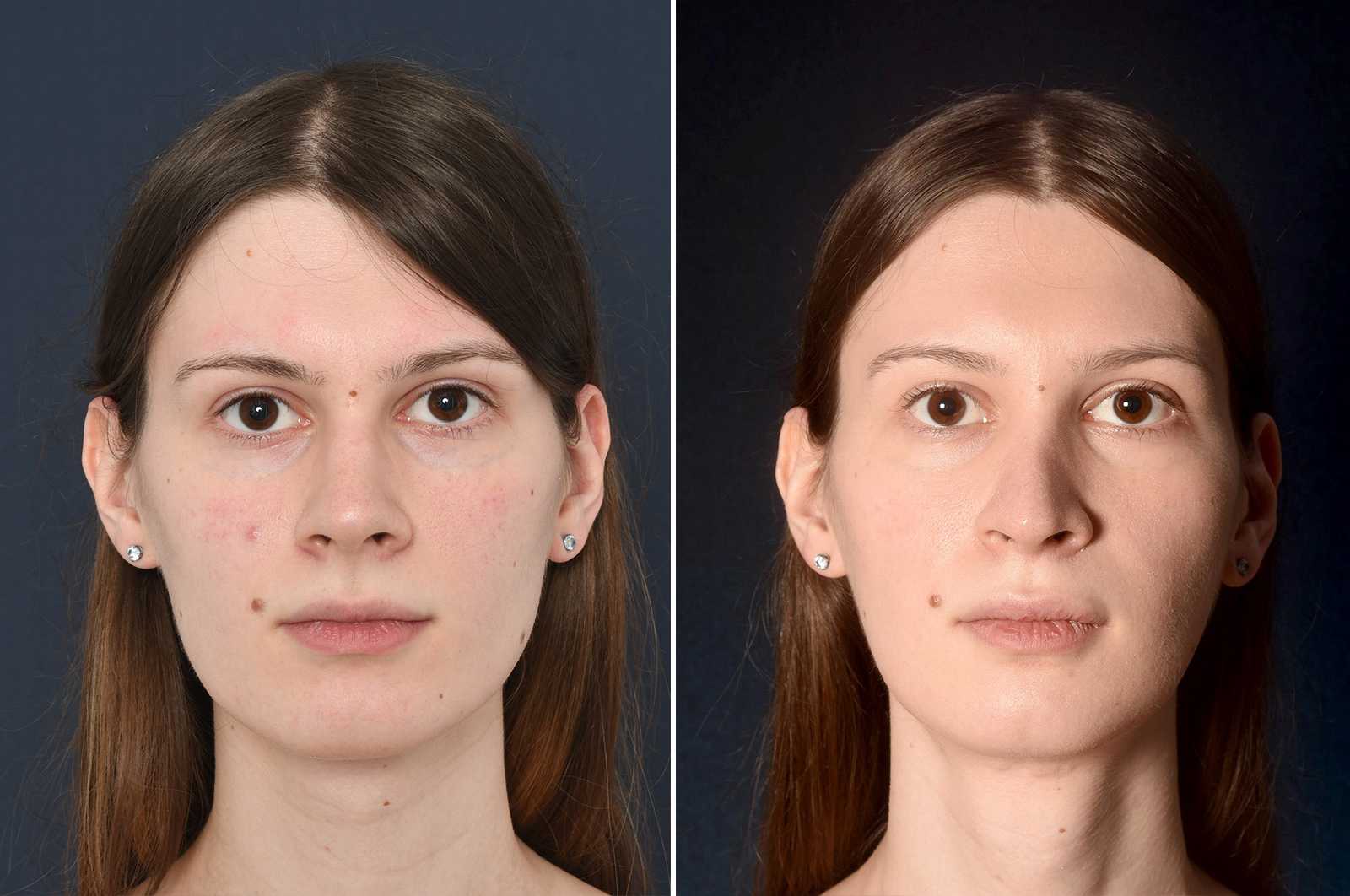 facial feminization software free