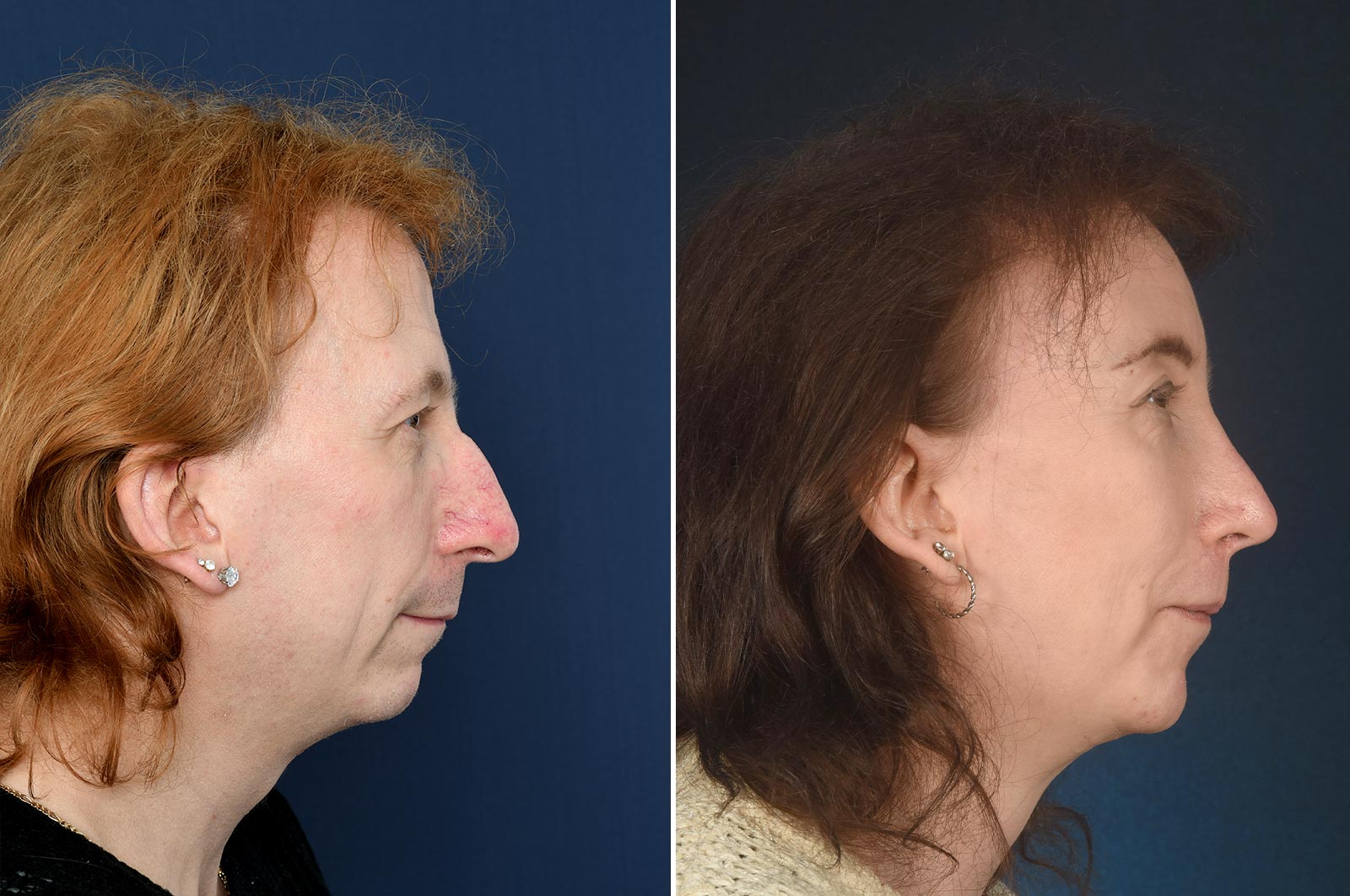 Signý Before And After Ffs 2pass Clinic 