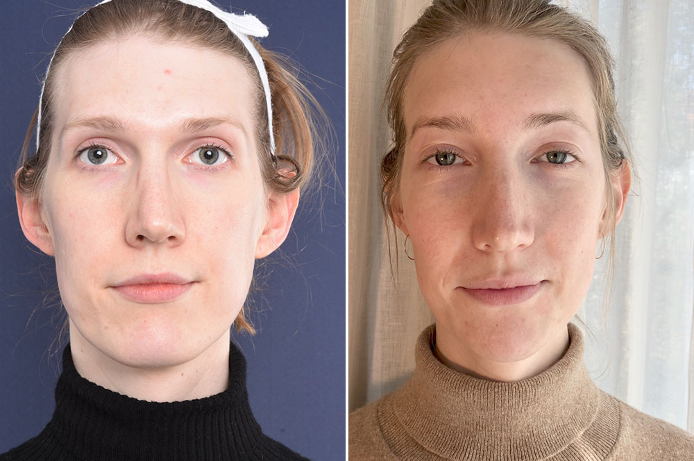 Steffie before and after FFS - 2pass Clinic.