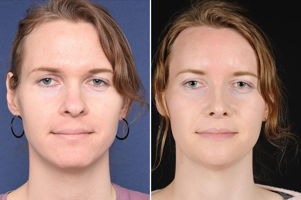 Alexandra before and after FFS - 2pass Clinic.