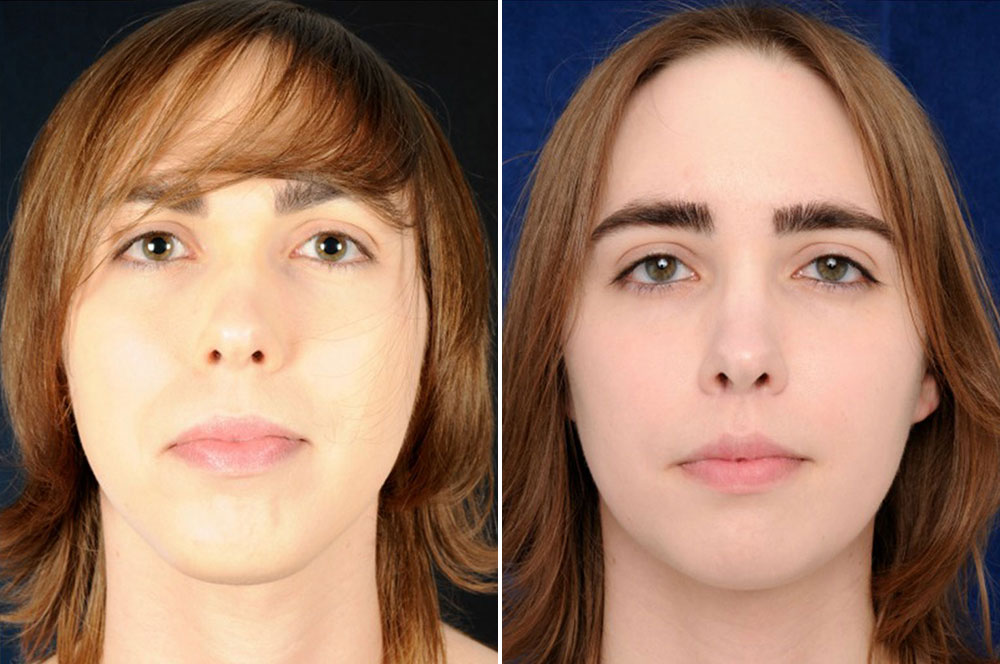 Françoise before and after FFS pass Clinic