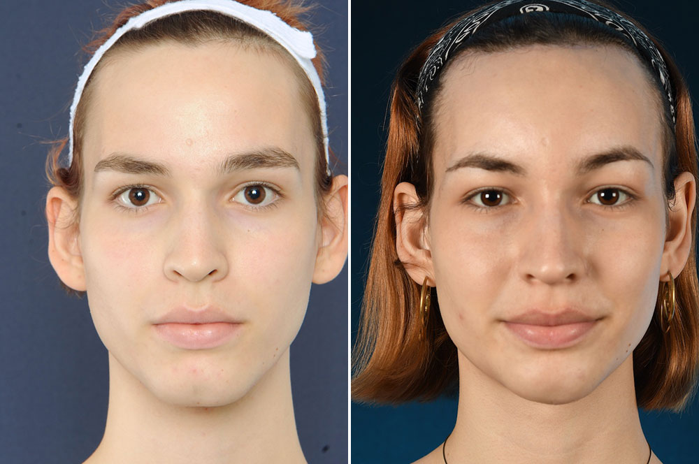 Brow lift, Chin surgery, Forehead recontouring.