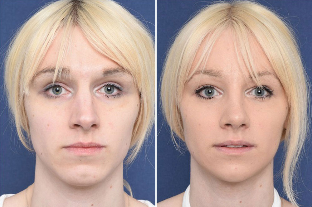 Ffs Surgery Before Freya Feminization Facial Reduction Chin 2pass Clinic Br...