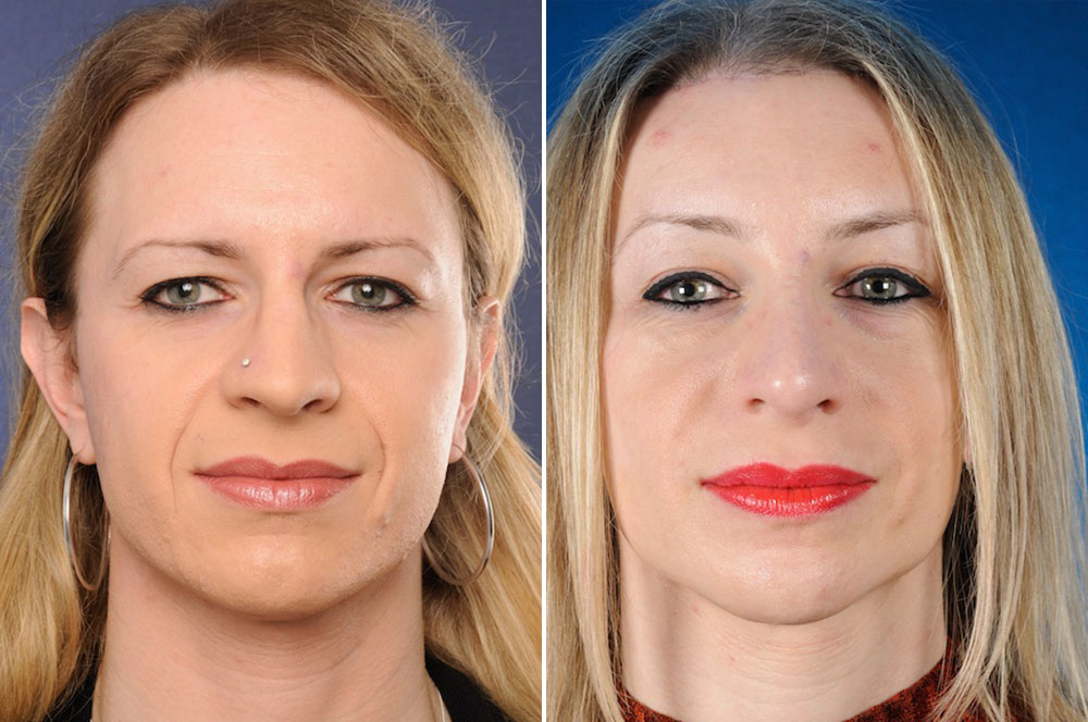 После post. Феминизация лица FFS. Face feminization Surgery до и после.