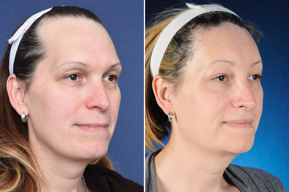Lena before and after FFS - 2pass Clinic.