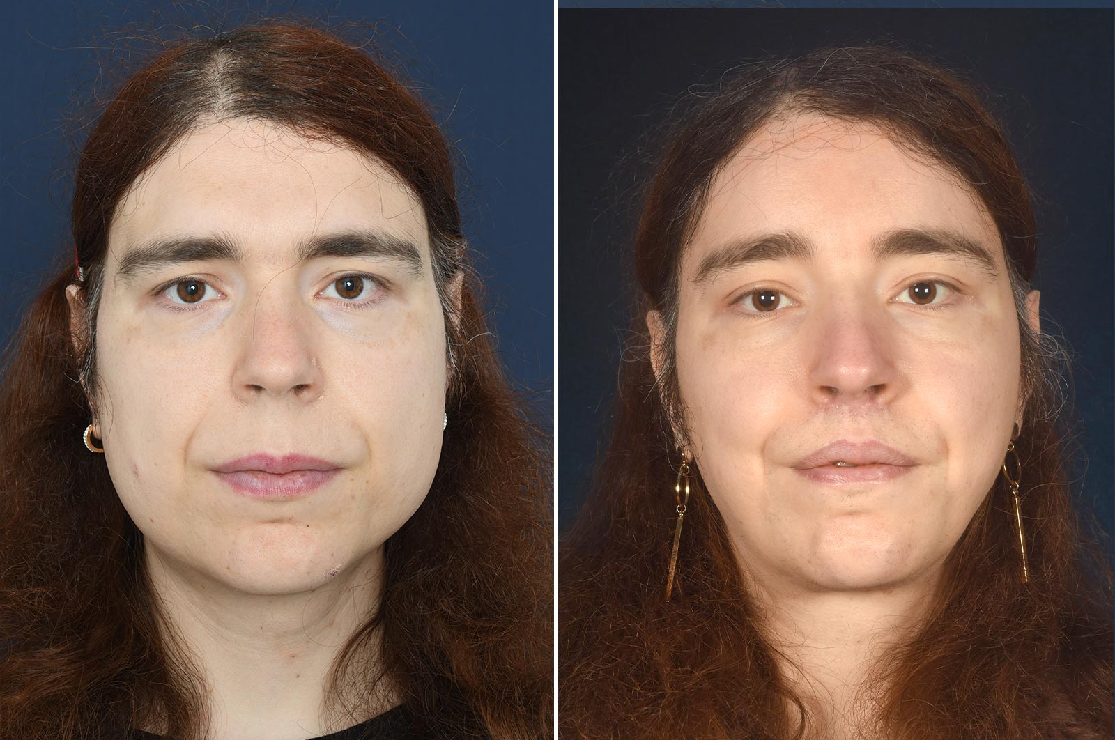 Nicole Before And After Ffs 2pass Clinic 3382